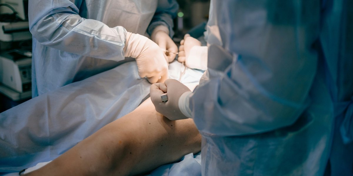 Radio Frequency Treatment for Varicose Veins: A Full-Body Reset